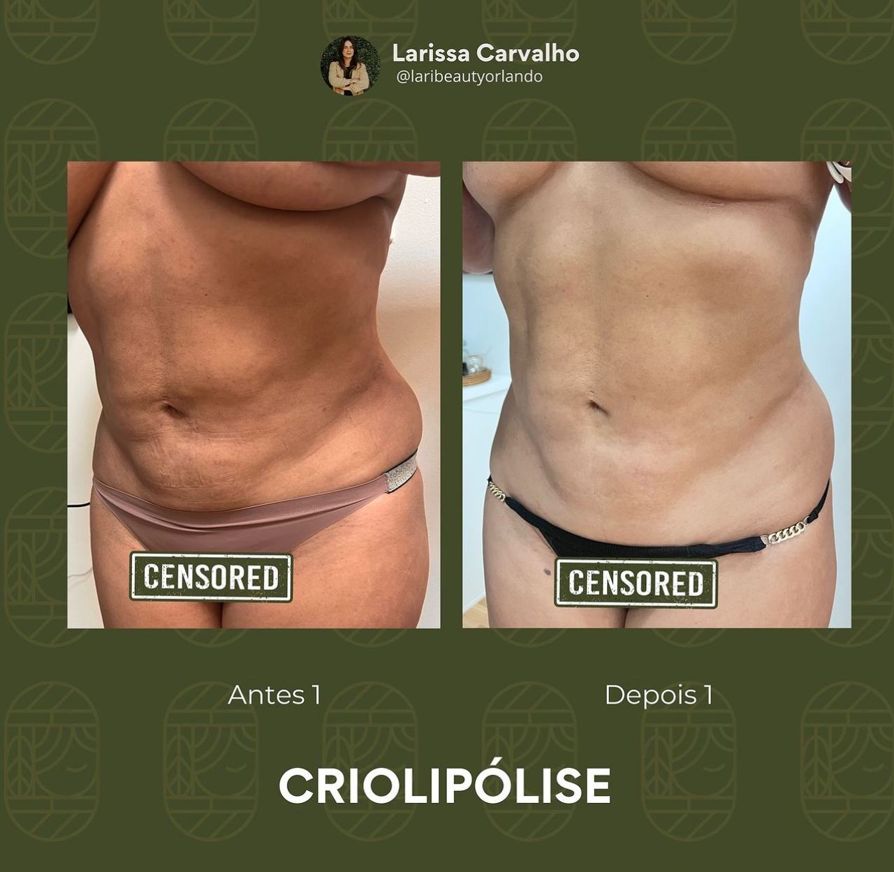 Cryolipolysis Treatment