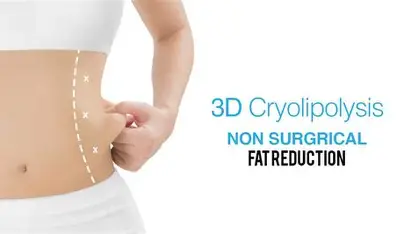Cryolipolysis – Fat Reduction Through Freezing